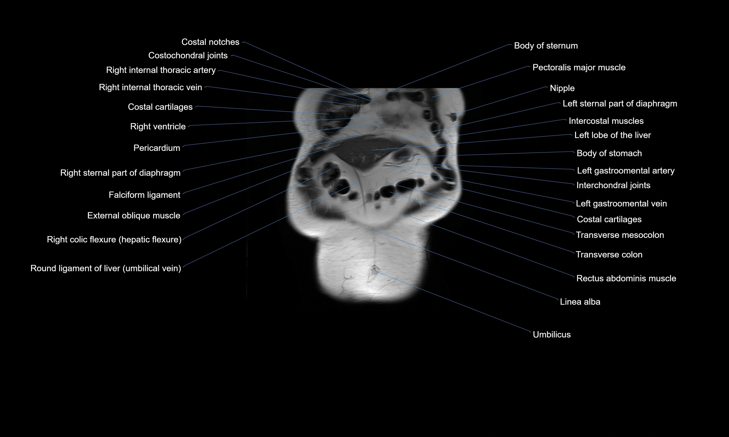 MRI Abdomen axial cross sectional anatomy radiology  image-img-00001-00009.webp